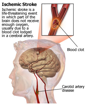 Stroke+ct+scan+images
