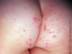 Topical steroids herpes zoster