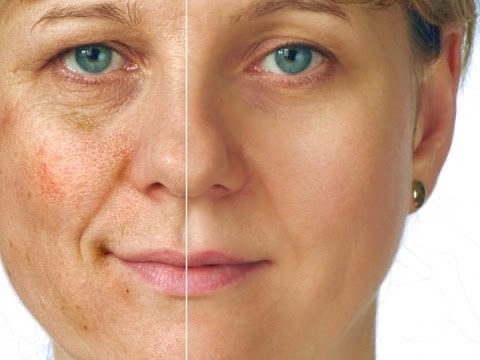 Tratamento Para Melasma