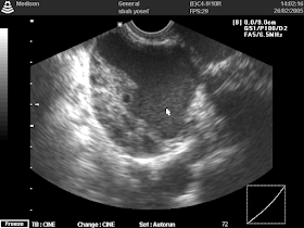 Endometrioma (chocolate cyst)-TVS done by Dr. Alaa Mosbah