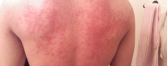 Allergic Reaction To Crab Cakes Allergic Reaction To Crab Cakes