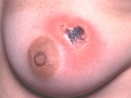 breast mastitis abscess Breast mastitis abscess