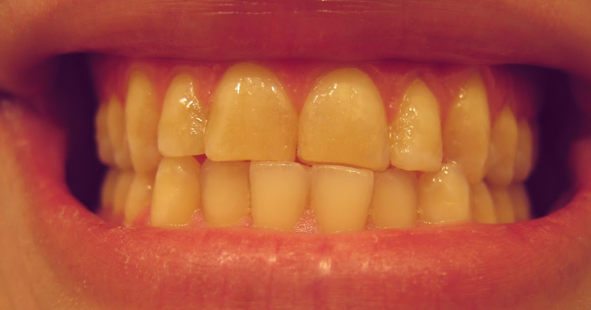 A Look At Gingivitis And Periodontal Disease How to stop grinding teeth