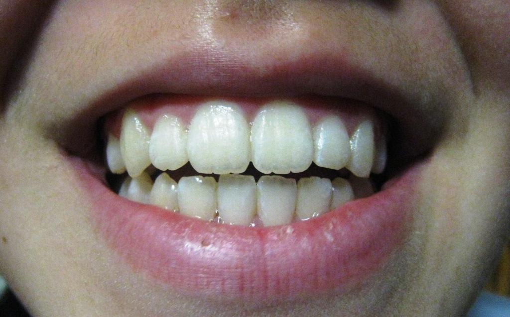 Life in Rural Japan Braces part 2