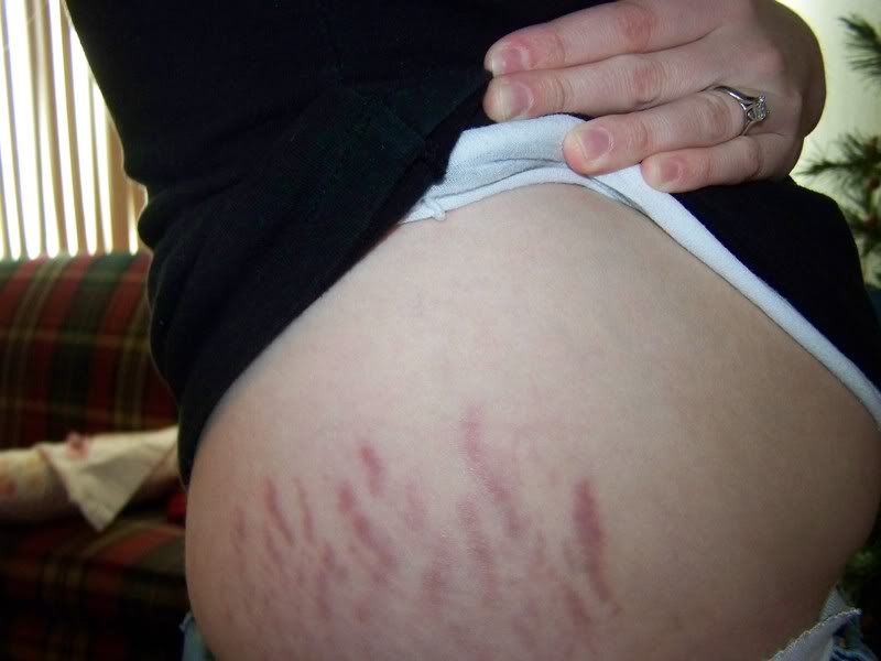 Huge Bump on inner thigh. inside stretch mark?? (Photo included