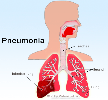 ICD 9 Code For Pneumonia