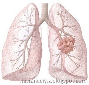 akciğer kanseri nedir