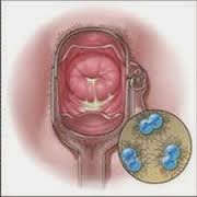 Flujo vaginal por tricomoniasis triconomiasis-prevencion-tratamiento