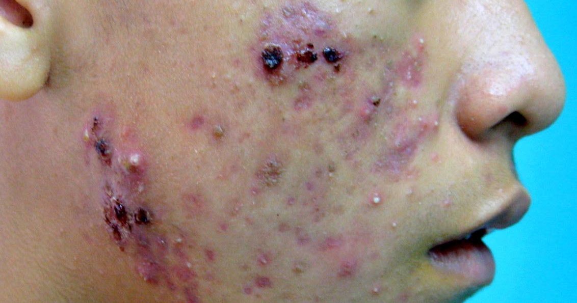 Acne vulgaris
