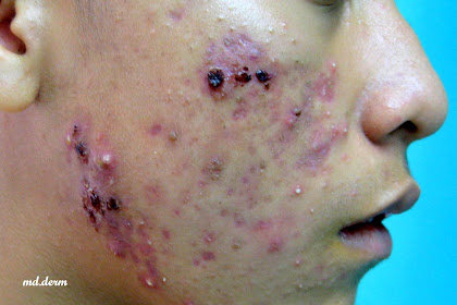 Everything You Ever Wanted To Know About Cystic Acne