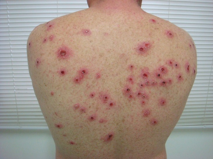 сыпь при вторичном сифилисе вторичный сифилис: высыпания