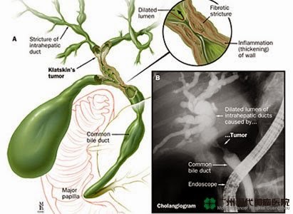 Cara untuk Mengobati KankerEmpedu Tanpa Operasi Cara untuk Mengobati KankerEmpedu Tanpa Operasi