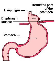 Hiatus Hernia: Great and bad the real Hiatus Hernia Diet plan