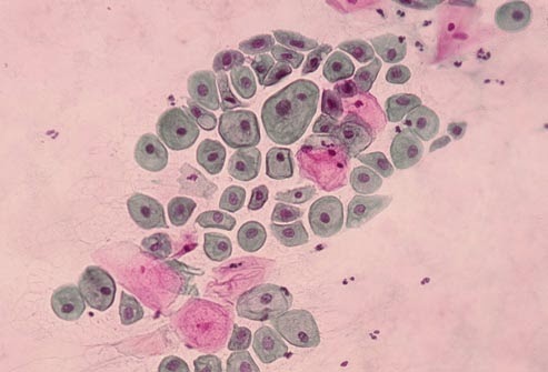 Communication on this topic: Cervical cancer vaccine is getting results, cervical-cancer-vaccine-is-getting-results/ Discussion on this topic: Cervical cancer vaccine is getting results, cervical-cancer-vaccine-is-getting-results/