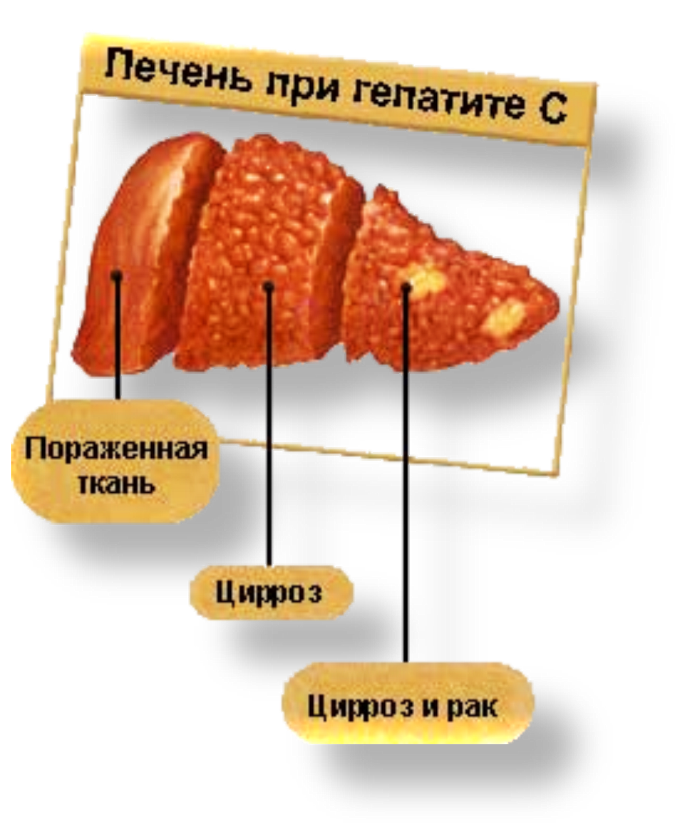 печень при гепатите с фото онлайн печень при гепатите с фото