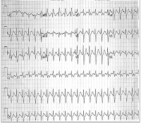 EKG of the Day (4/29)