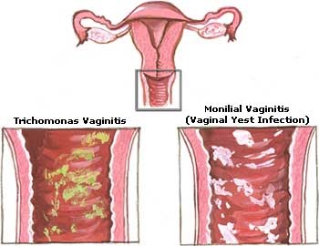 can u get a yeast infection while pregnant