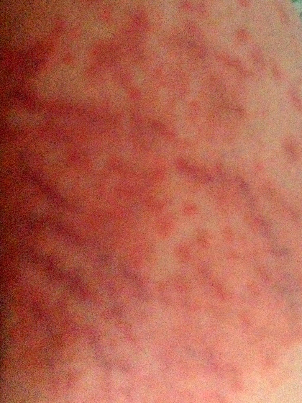 My Peanut Butter Problem: Surviving A Puppp Rash - 1024x1366 - jpeg C Section Scar Rash