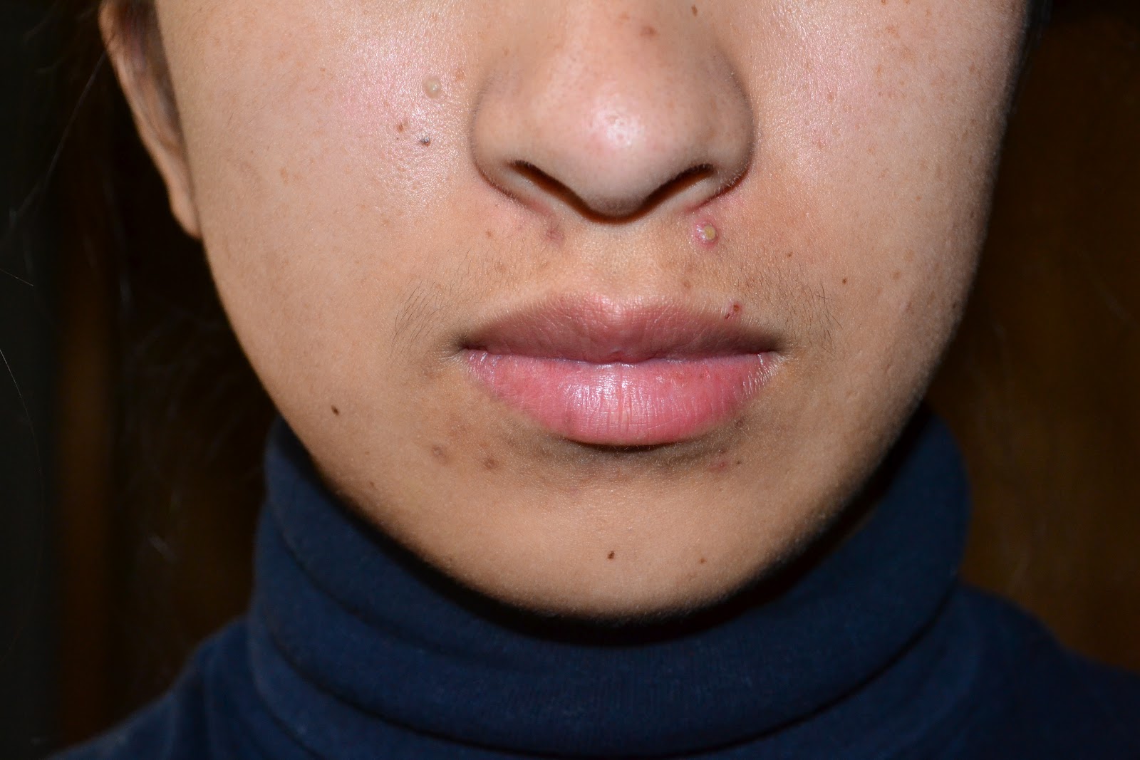 Face With Blemishes