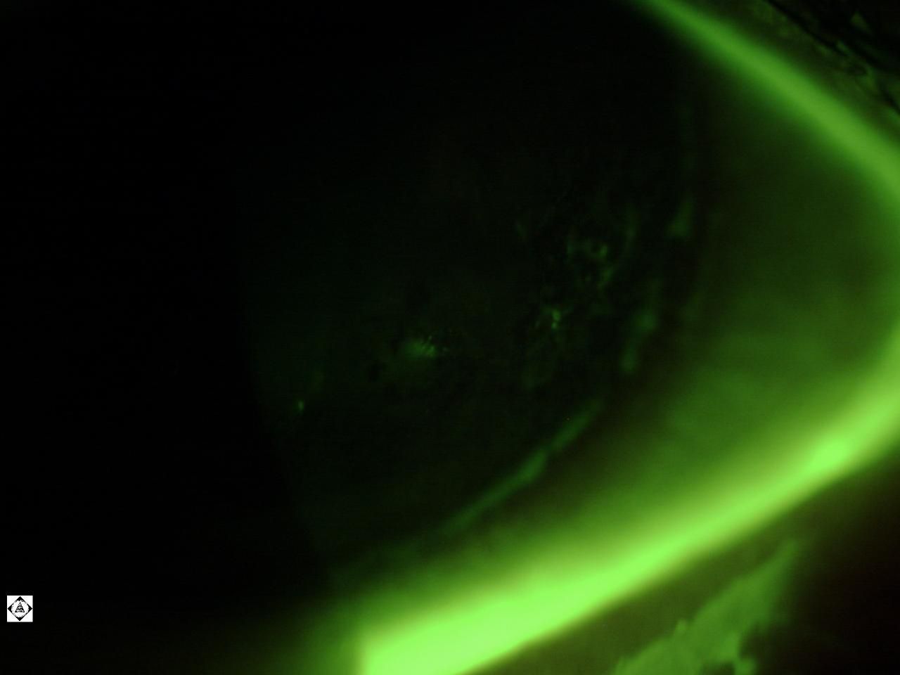 HERPES SIMPLEX KERATITIS Sonoran Desert Eye Center