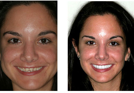 dental treatments hyderabad best dentist in india dental bonding cost