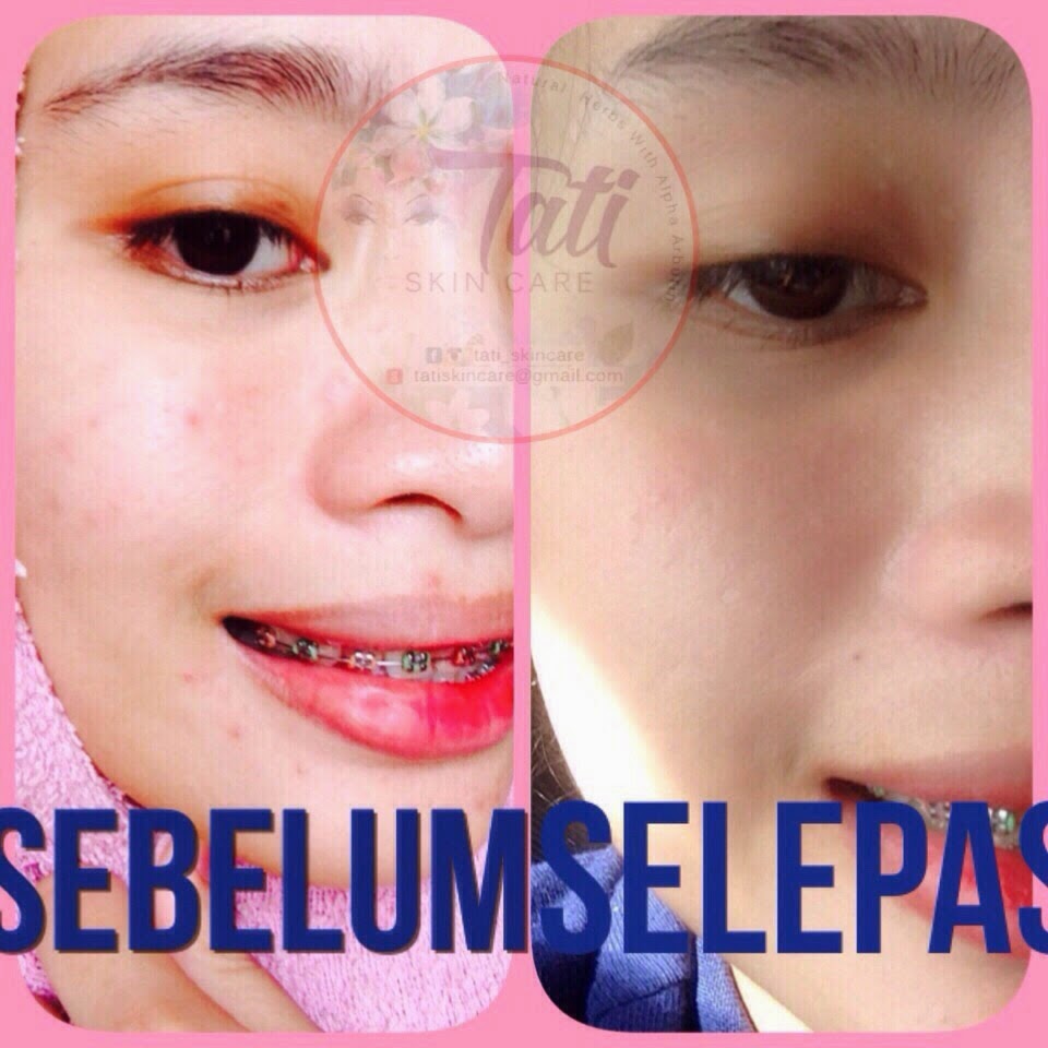 By Mommy Haziq Tati Skincare Buat Kulit Muka Saya Jadi | tati skincare 5 in 1 stokis agen pengedar borong By Mommy Haziq Tati Skincare Buat Kulit Muka Saya Jadi | tati skincare 5 in 1 stokis agen pengedar borong