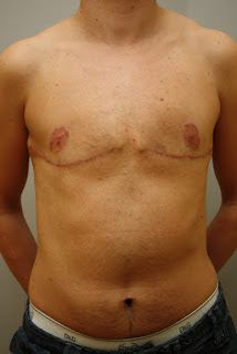 after breast removal surgery photos