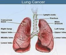 obat alternatif tumor Paru, obat kanker paru, pengobatan kanker paru