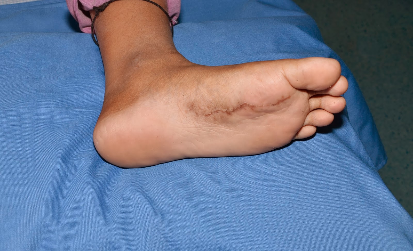 CRUSH INJURY FOOT, LOWER LIMB INJURIES AND LIMB SALVAGE ARTERIOVENOUS