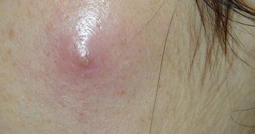 abscess treatment