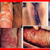 Obat Antibiotik Bentol dan Gatal Pada Batang Penis thumbnail