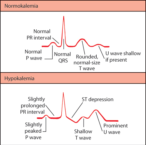 Bigeminy Ekg