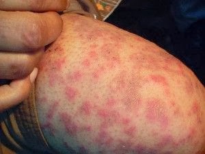 How to treat the skin dryness how to get the moisturized skin How to treat the skin dryness how to get the moisturized skin new images How to treat the skin dryness how to get the moisturized skin How to treat the skin dryness how to get the moisturized skin new photo