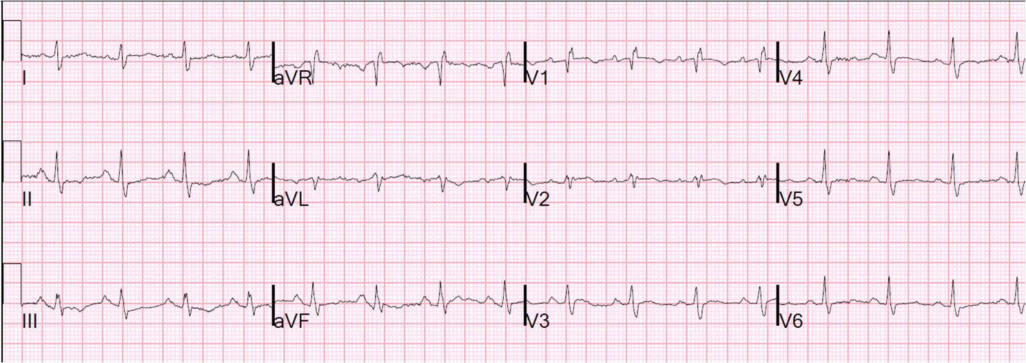 Dr. Laxman Dubey Q wave in lead V1V2