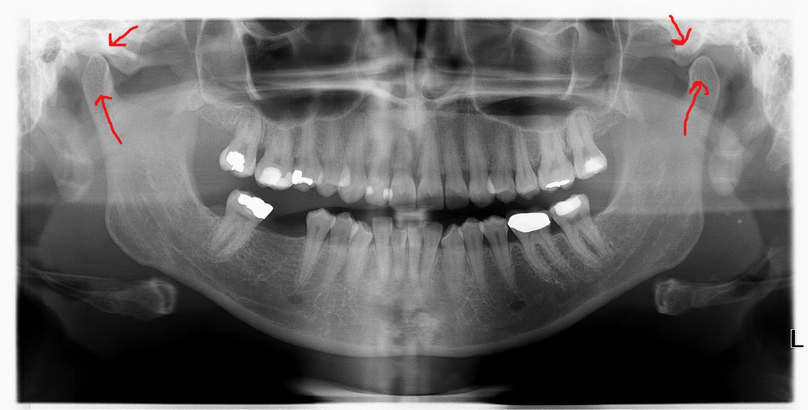 Jaw Surgery Fundraiser