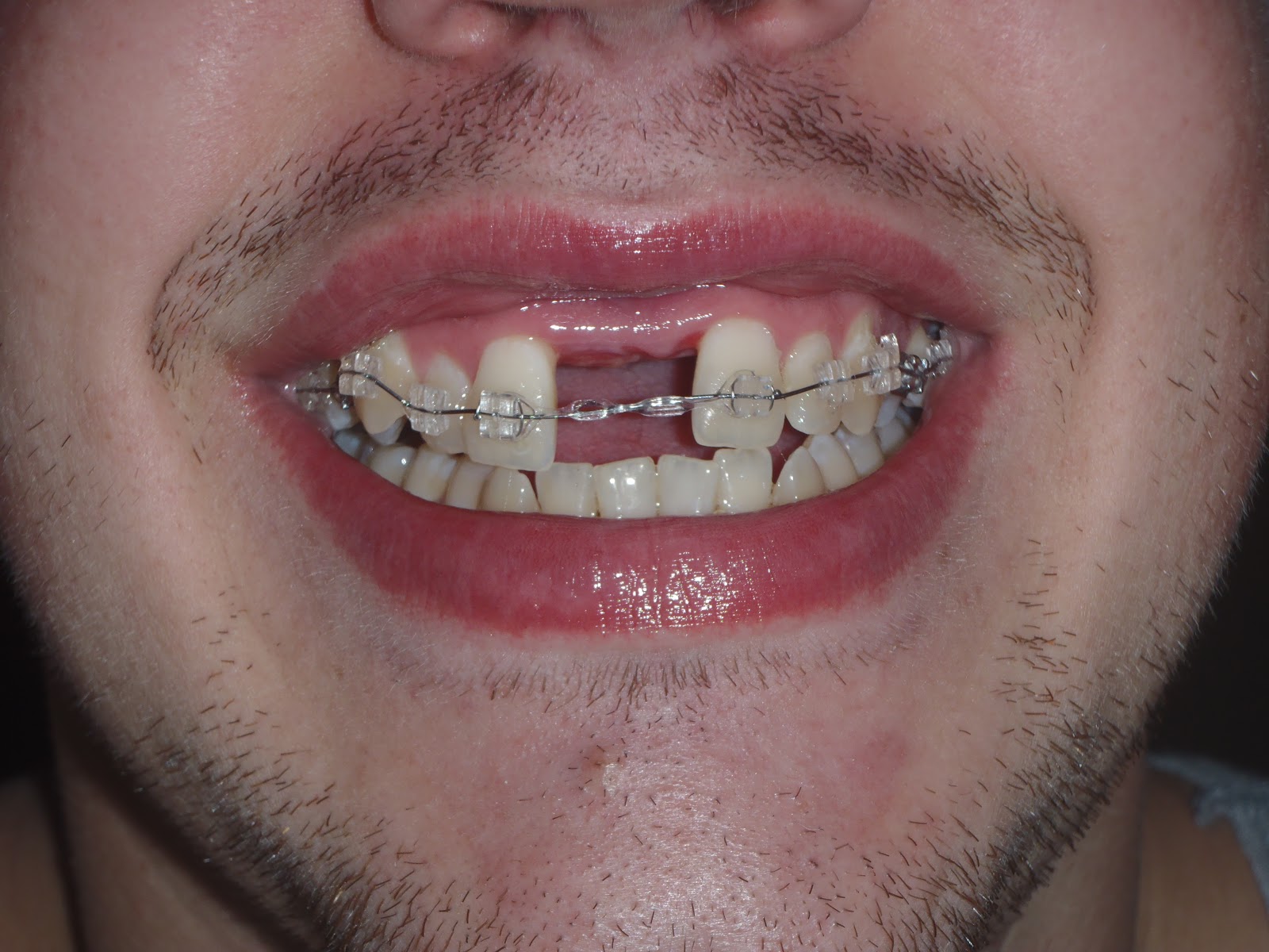 My SARPE Story Stalemate Braces vs The Expander!