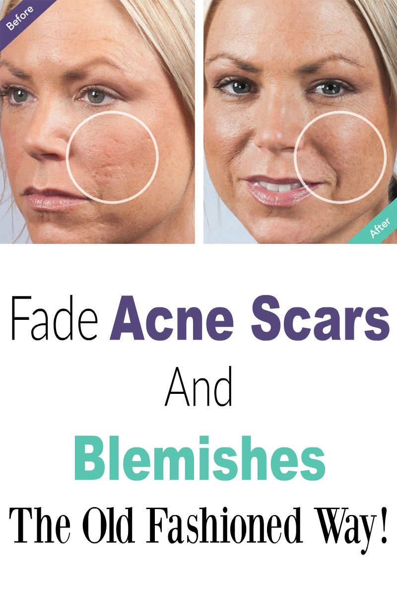 Skin Care And Health Tips Fade Acne Scars And Blemishes The Old