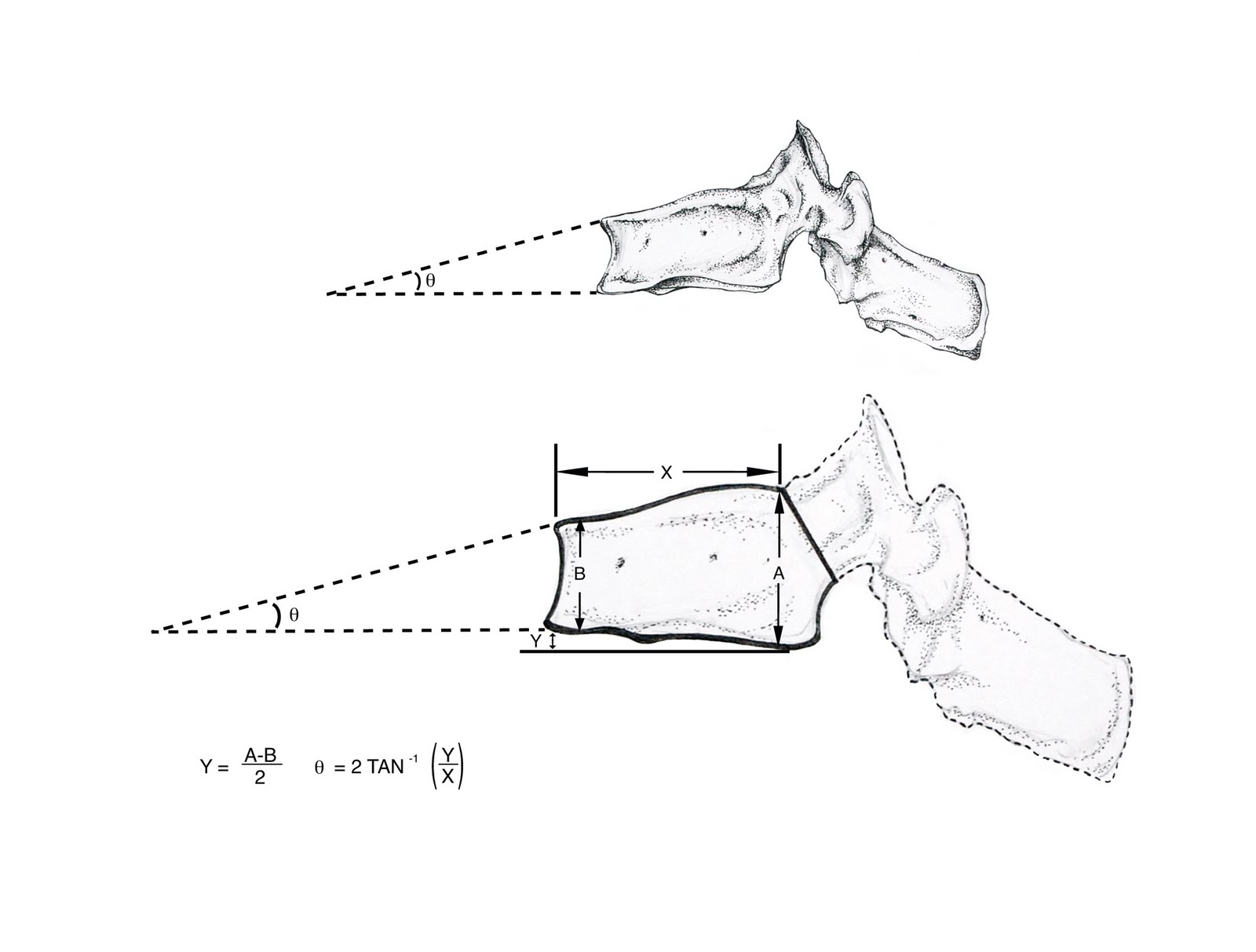 Kate Daly Medical Illustration Vertebral Wedge Angle Illustration