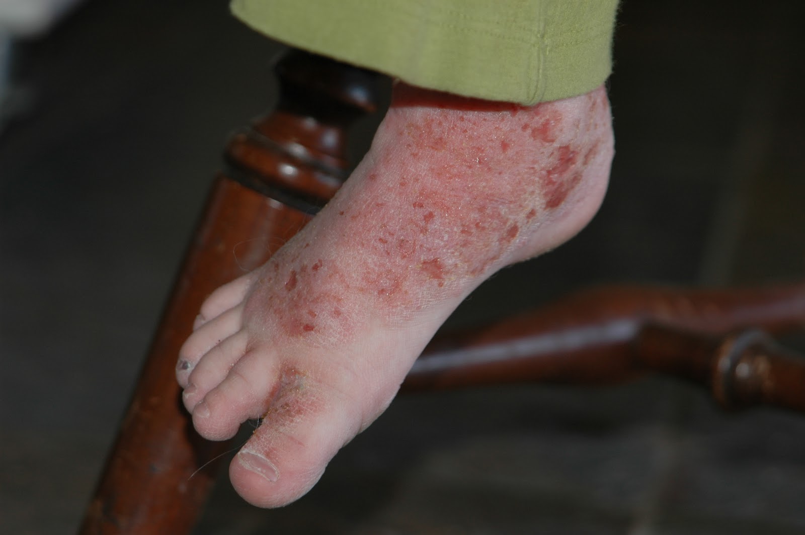Kline's road from out of control eczema to topical steroid withdrawal