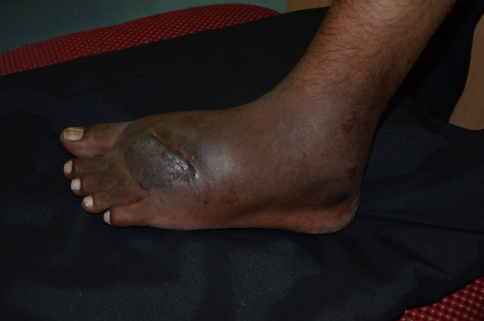 NON HEALING WOUND DORSUM FOOT POST TRAUMATIC INFECTIONS, DIABETIC FOOT, NON HEALING WOUNDS
