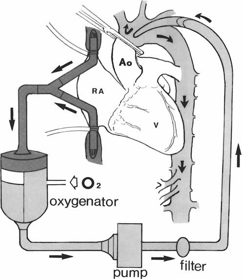 IDA TIUR SIMANJUNTAK: Cardiopulmonary Bypass and Cardioplegia