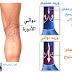 دوالي الاوردة، دوالي الساقين Varicose veins