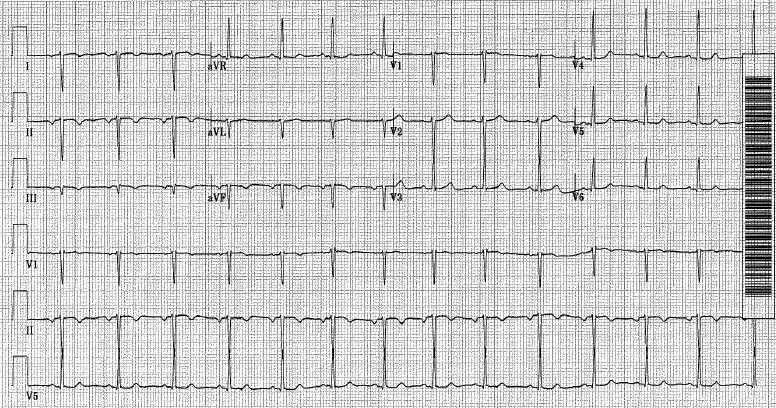 Everyday E(B)M: EKG Challenge No. 12 Case Conclusion: Because We're
