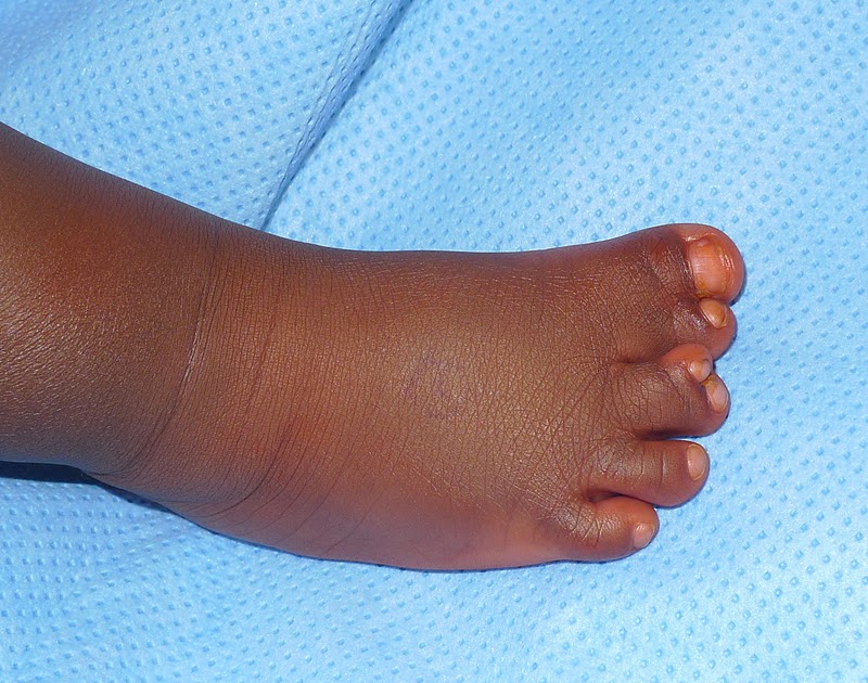 Toe Polydactyly Congenital Hand and Arm Differences