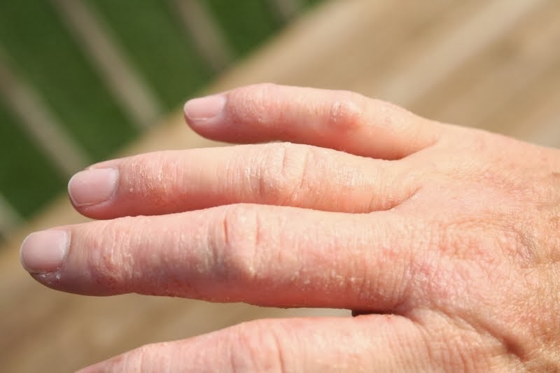 Extremely Dry Cracked Hands