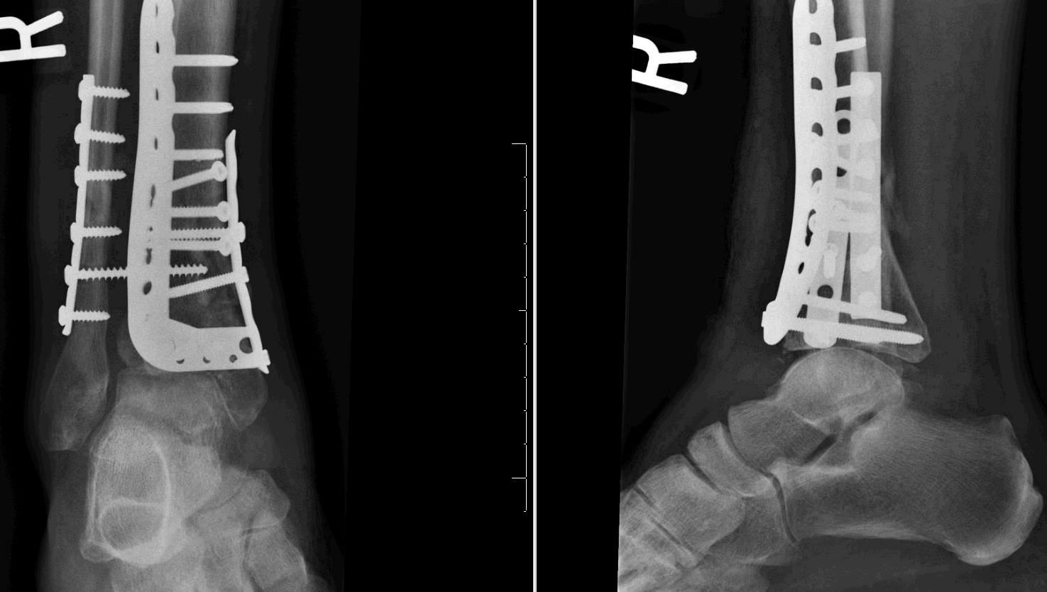 dr christopher lu mbchb frcsc tibial plafond fractures tibial plafond