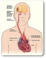 Obat herbal stroke