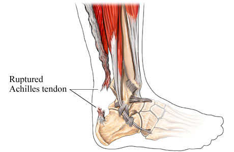 Test To See If Achilles Tendon Is Ruptured