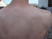 . only the Deer Ticks carry that disease and this was in fact a Dog Tick. (gagetic )
