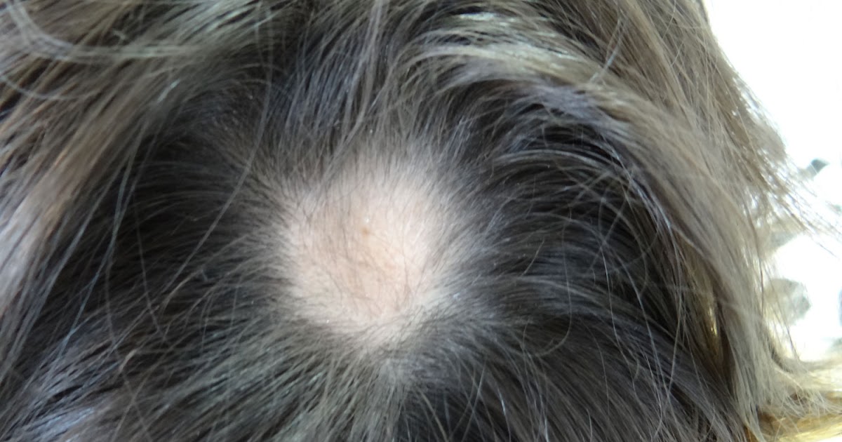El tratamiento del cuero cabelludo y el cabello después de la coloración
